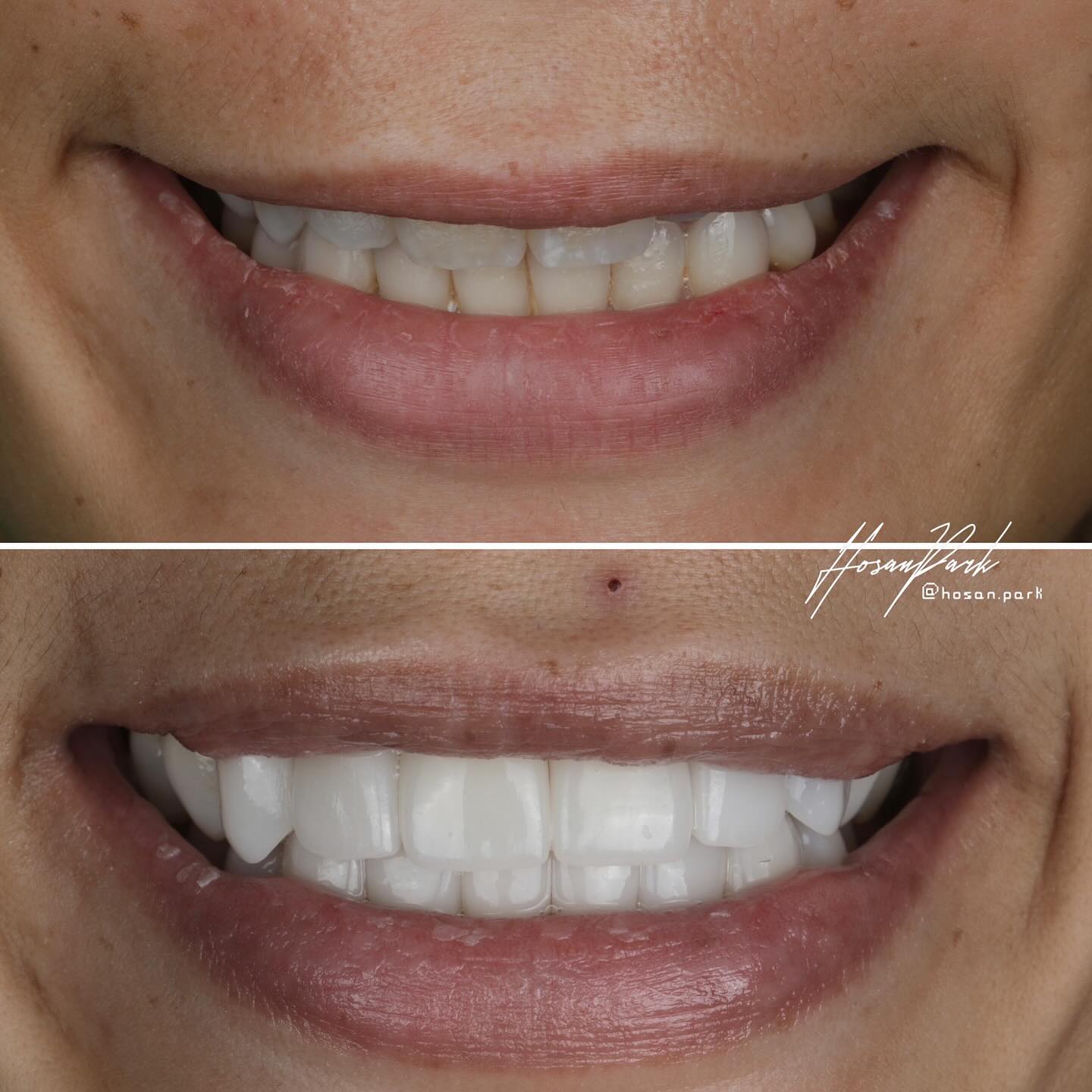 Smile before and after veneers treatment