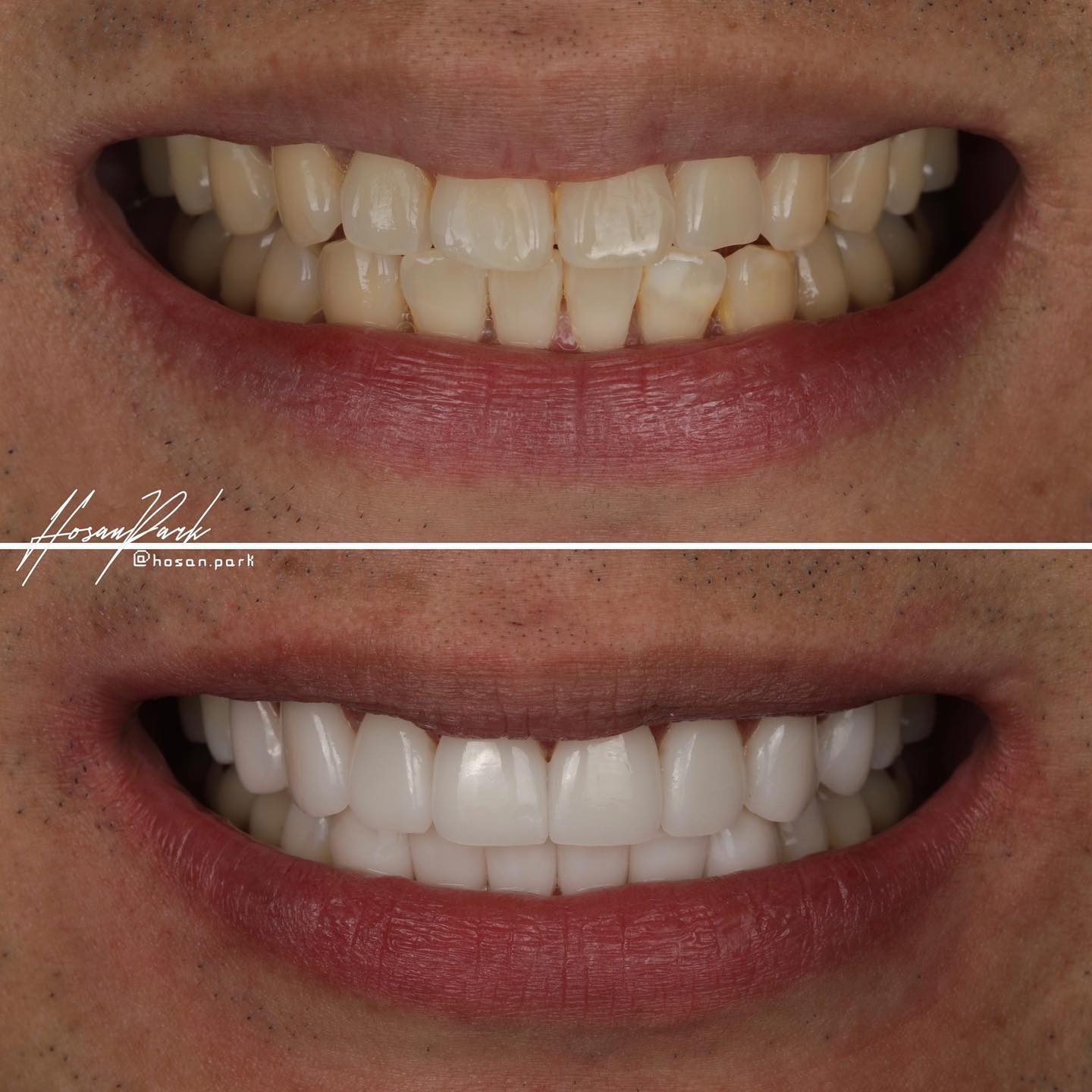 Before and after minimal-prep veneers in Seoul