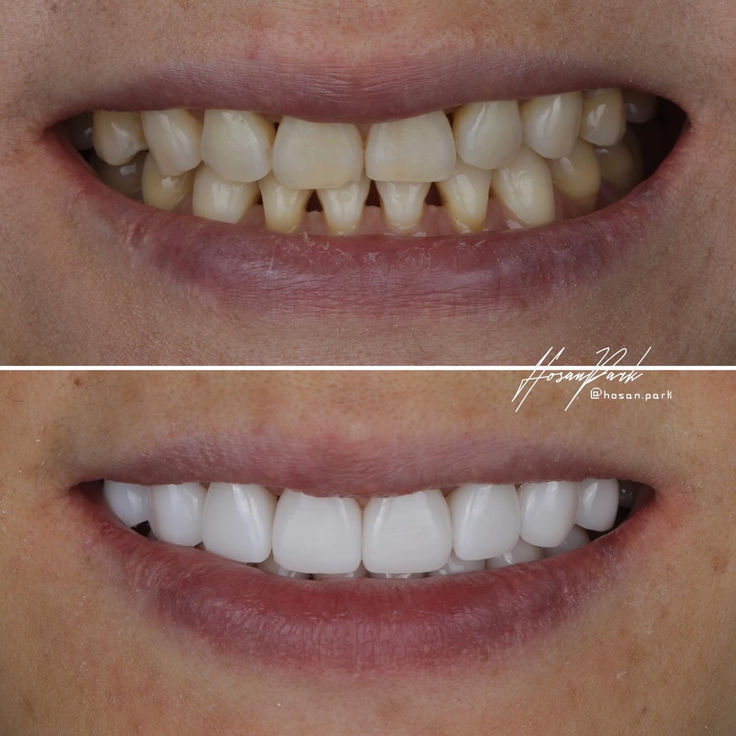 Before and after black triangle correction