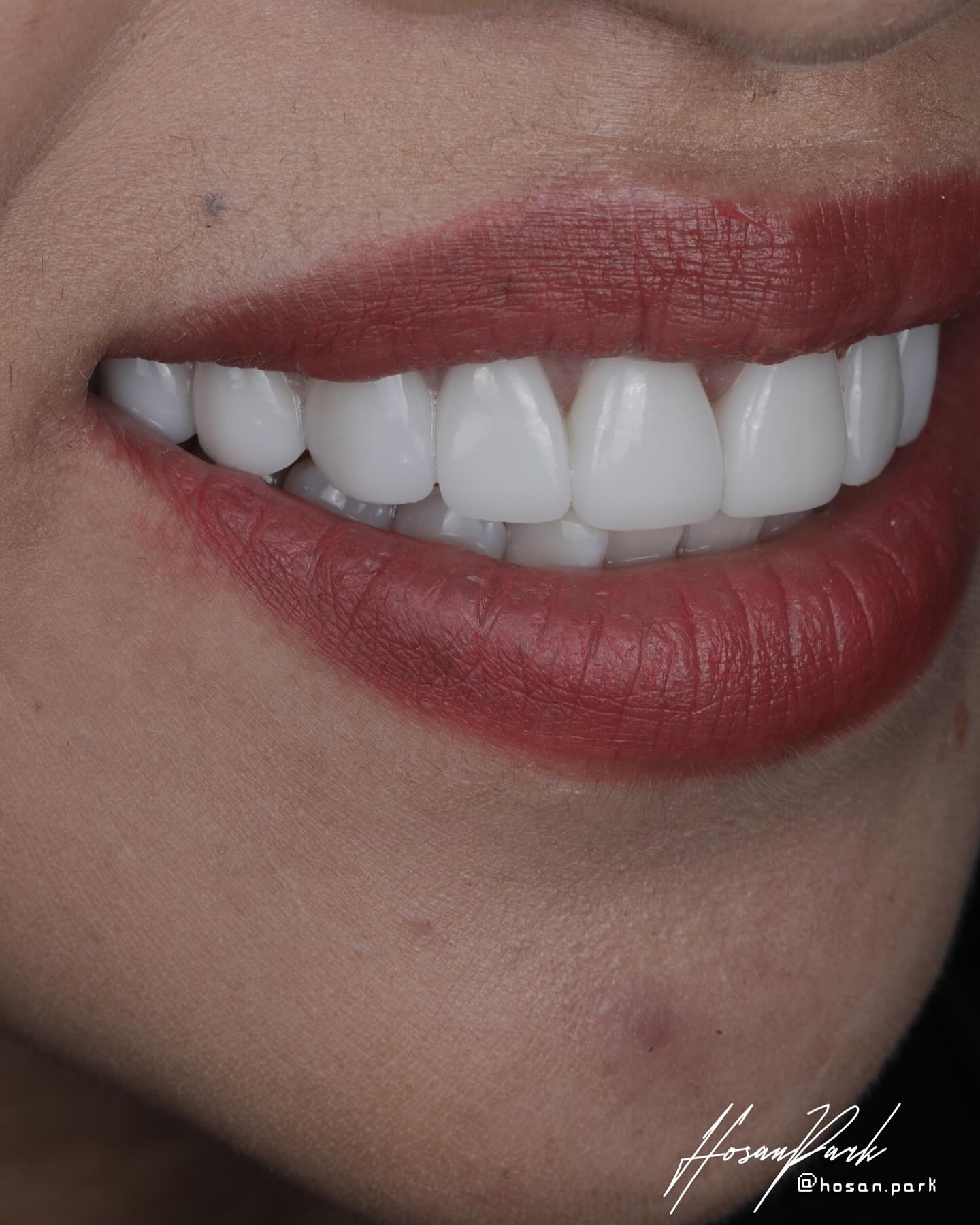 Bright smile after e.max veneer treatment