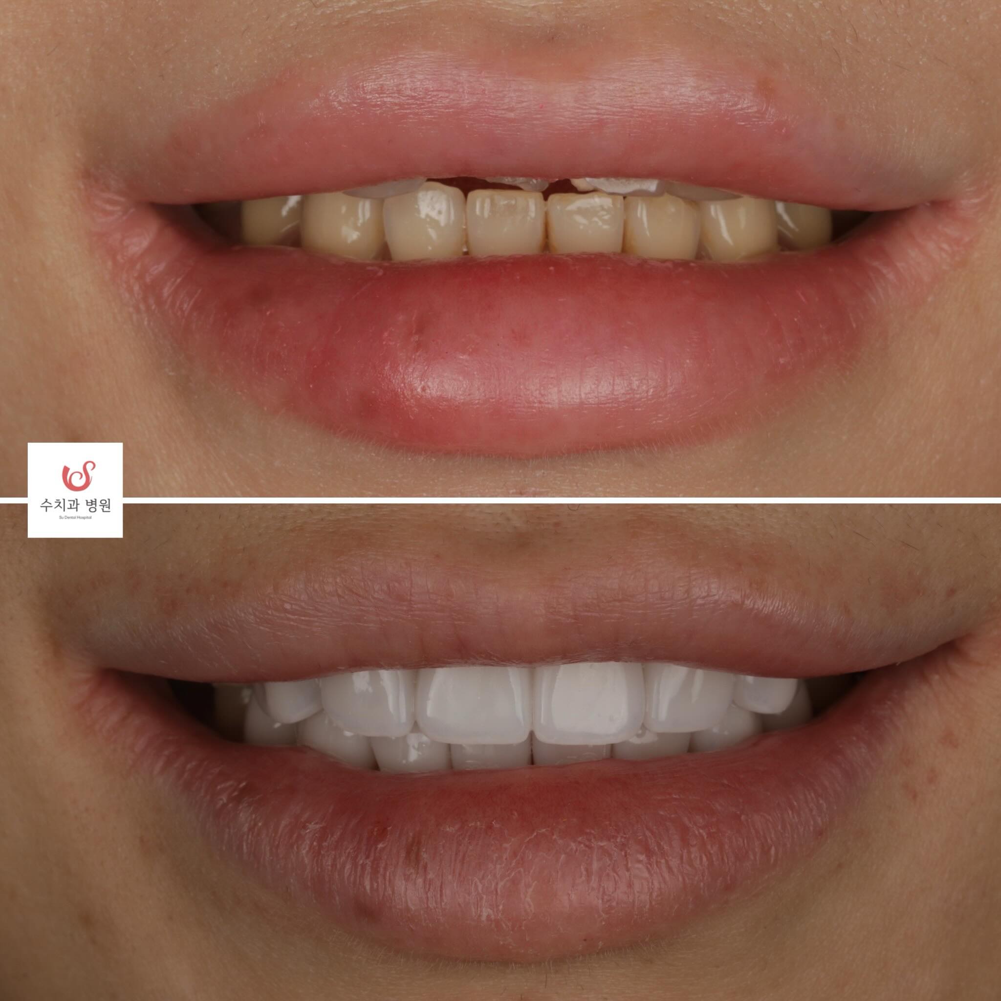 Natural white veneer smile before and after