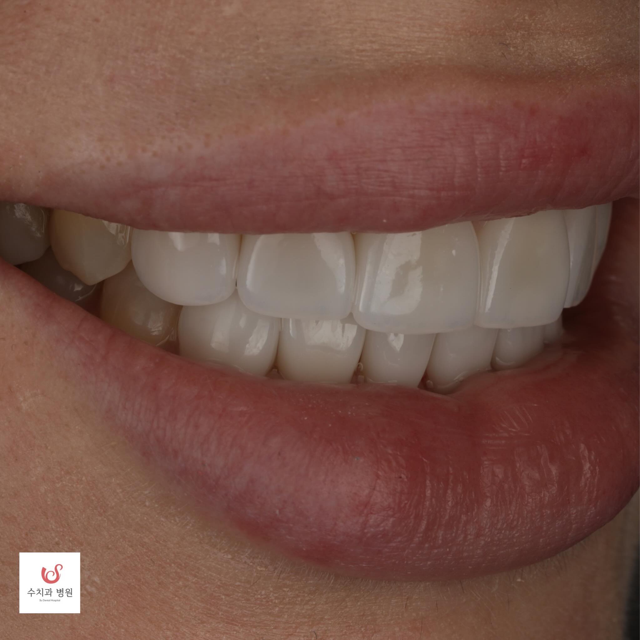 Full smile makeover before and after