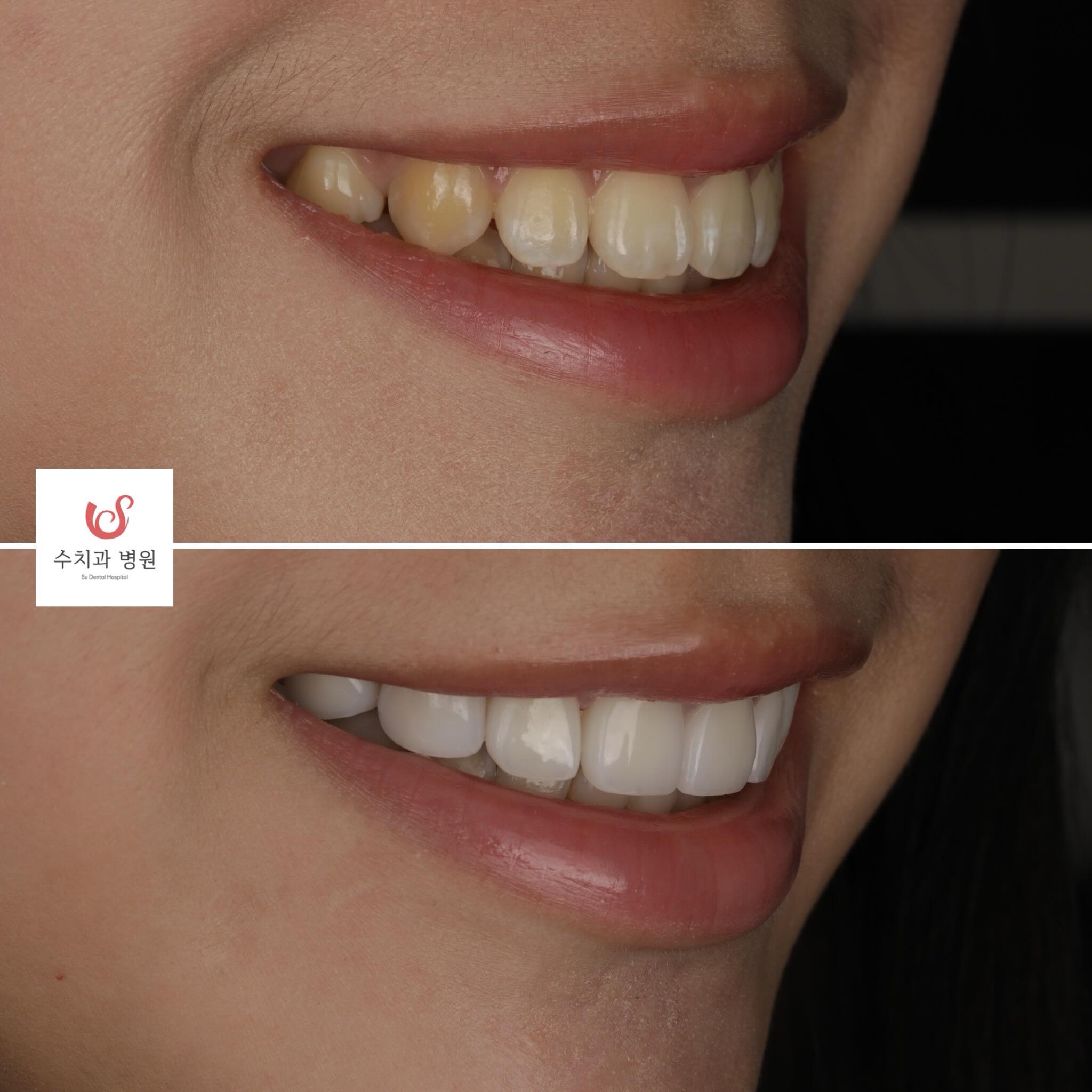 One-day laminate veneers result