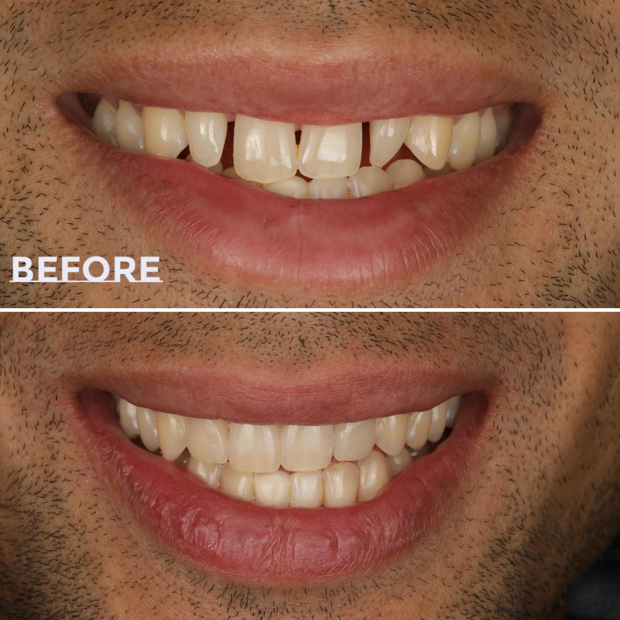 Two e.max veneers before and after
