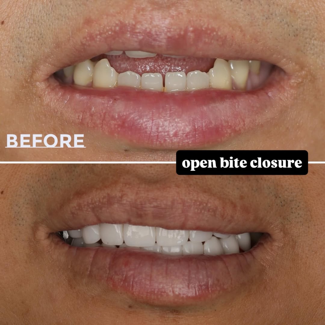 Open bite closure before and after