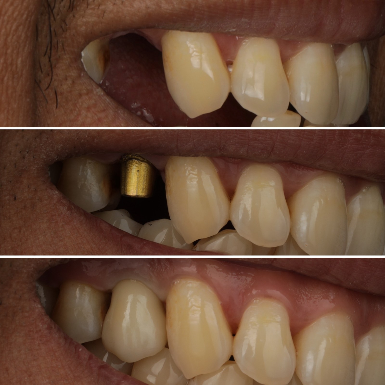 Straumann BLX implant before and after