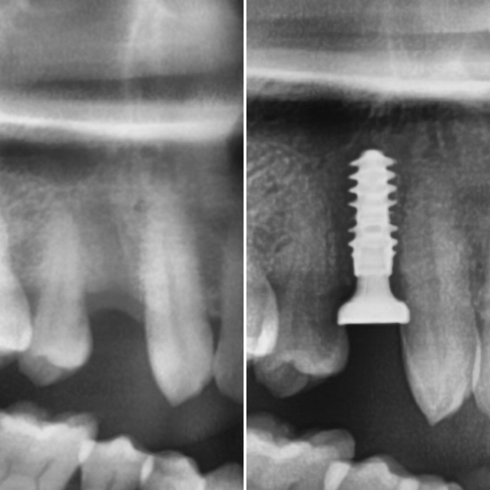 Dental implant radiograph after placement