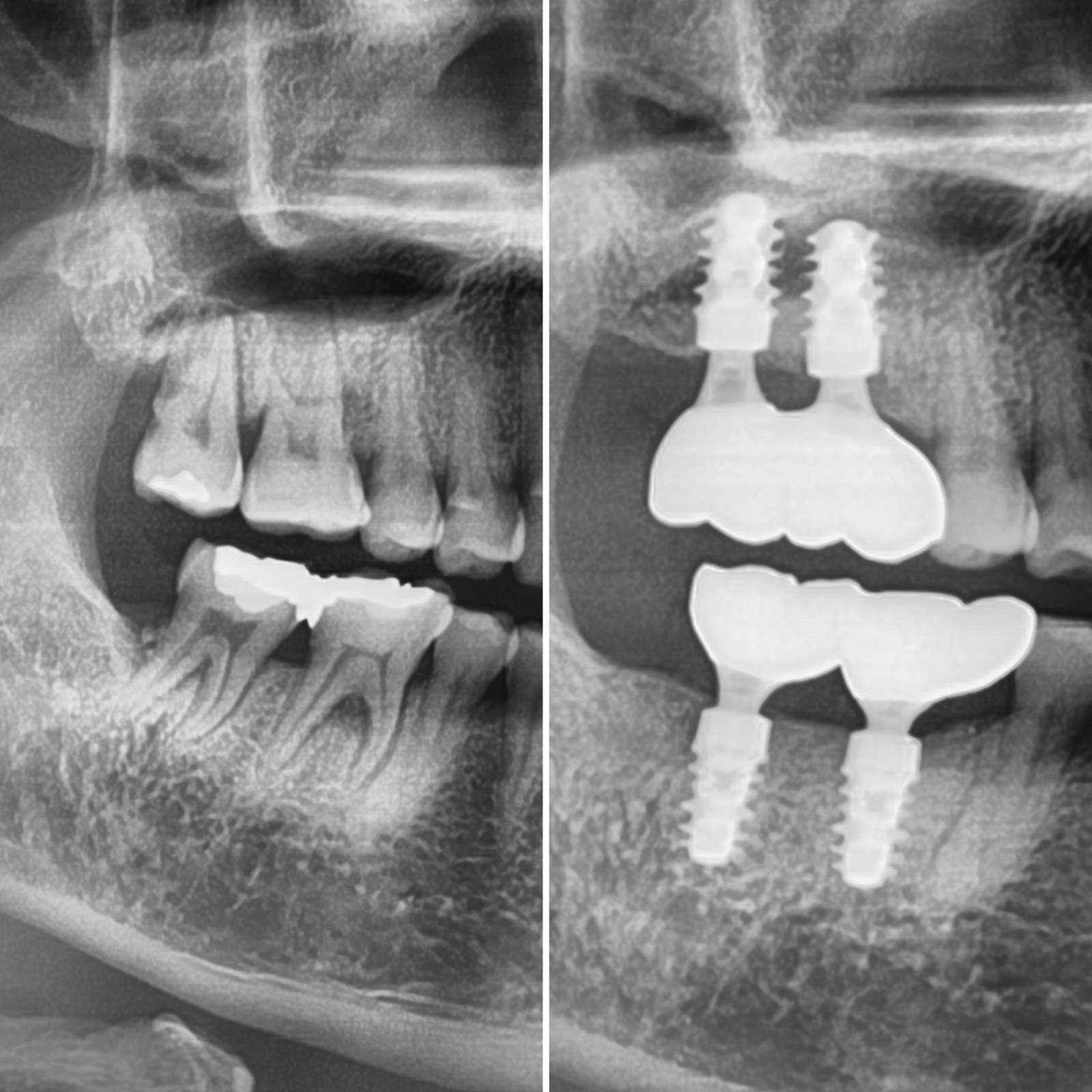 Guided Straumann implant radiograph