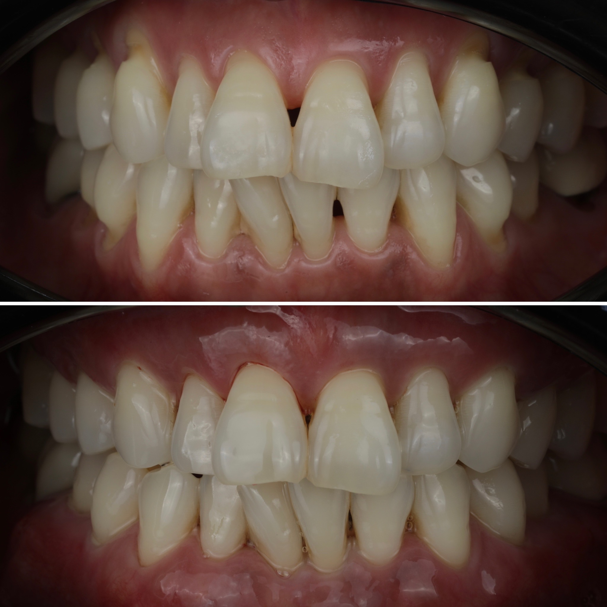Lower anterior recession: clinical photographs before and after treatment