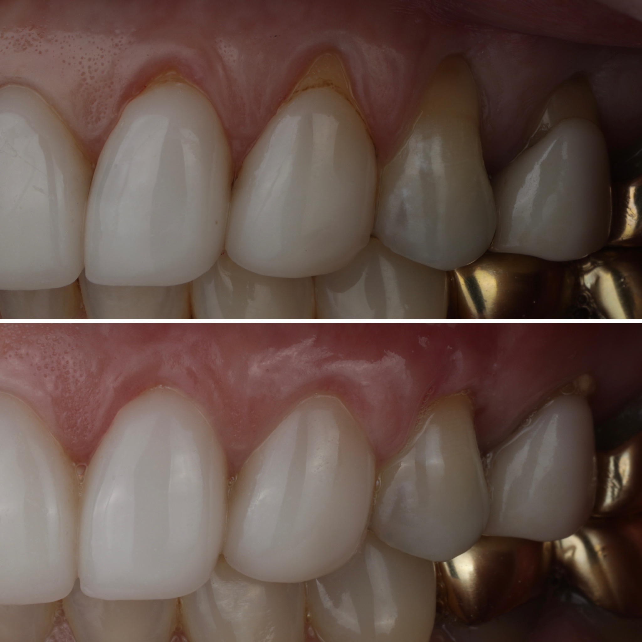 Upper canine gum recession before and after root coverage treatment
