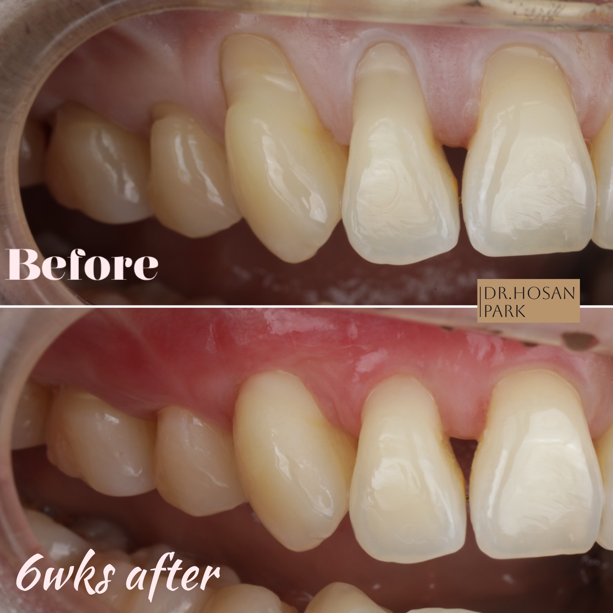 Six-week healing review: clinical photographs before and after treatment